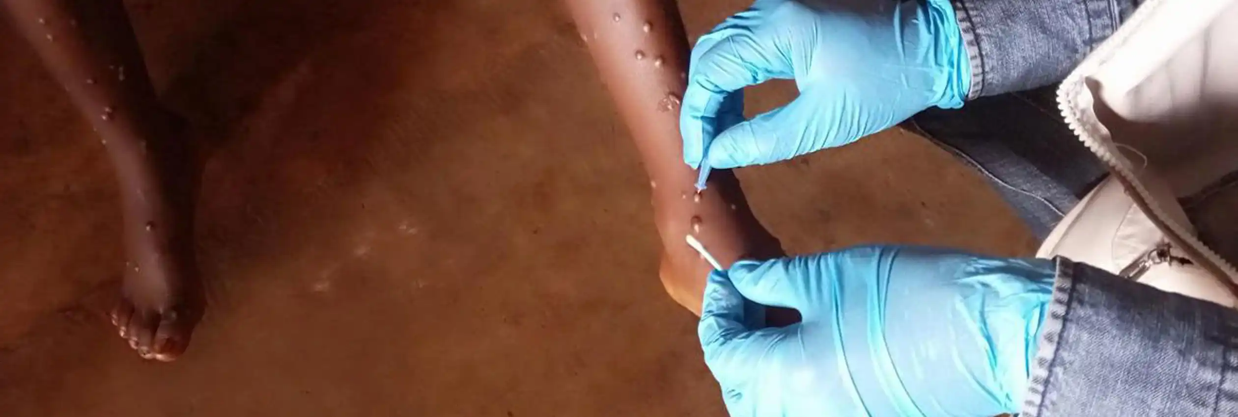 Mpox Emergency